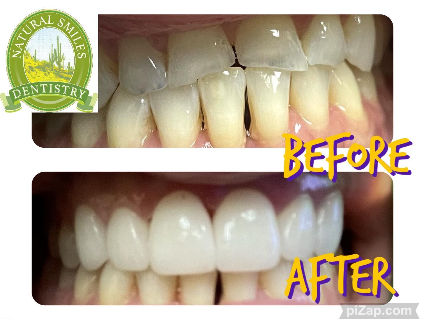 Smile transformation before and after — Natural Smiles Dentistry, Chandler AZ